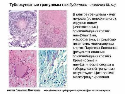 Гранулема туберкулеза