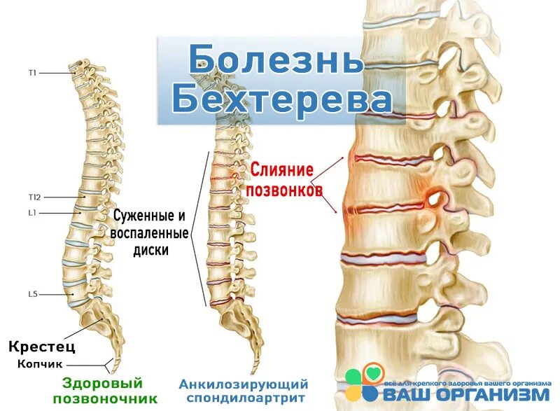 Анкилозирующий спондилоартрит (болезнь бехтерева) симптомы. Ювенильный анкилозирующий спондилит. Анкилозирующий спондилит болезнь бехтерева. Болезнь бехтерева поражение суставов. Срастание позвонков болезнь бехтерева.