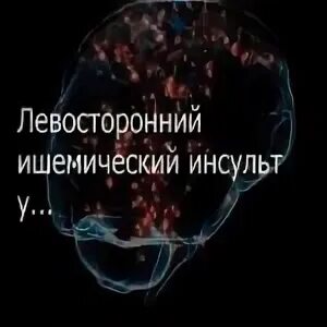 Левосторонний инсульт