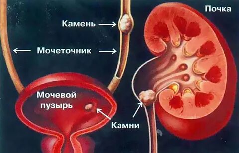 Боль в мочеточнике у мужчин