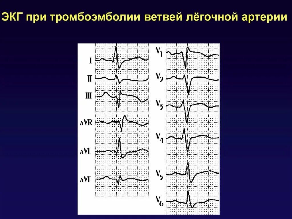 Тромбоэмболия легочной артерии экг. ЭКГ при неотложных состояниях. Тромбоэмболия легочной артерии на ЭКГ. ЭКГ при тромбоэмболии легочной. Тэла на ЭКГ.