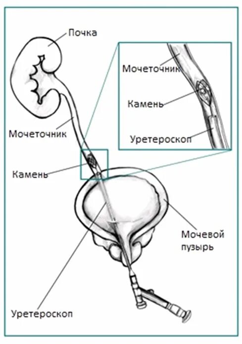 Как выводить камень из мочеточника. Камни в почках мочеточнике и мочевом пузыре. Контактная литотрипсия камней мочевого пузыря, мочеточника. Мочекаменная болезнь камни мочеточников клиника. Камень в мочеточнике уретероскопия.