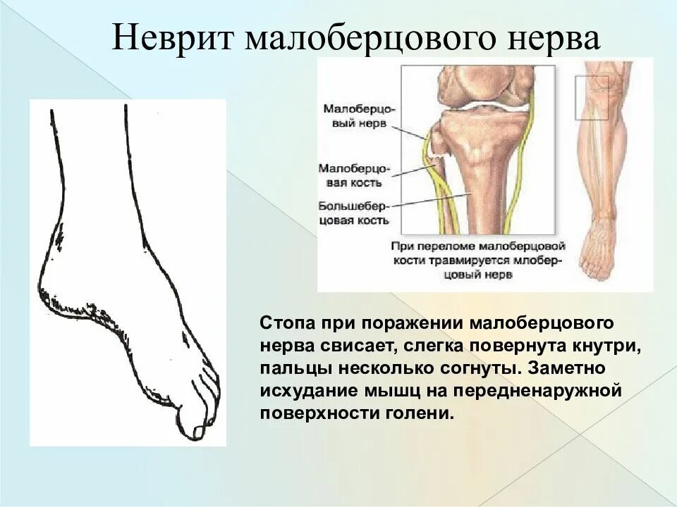 Мало поражении. Повреждение поверхностного малоберцового нерва. невропатия малоберцового нерва симптомы. синдроме компрессии общего малоберцового нерва. малоберцовый нерв на стопе.
