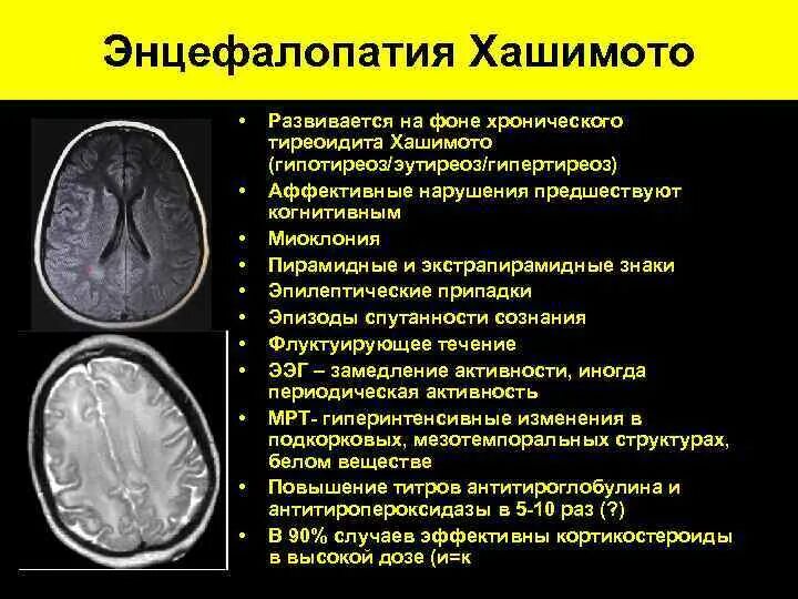 Энцефалопатия Хашимото. Энцефалопатия Хашимото мрт. Энцефалопатия головного мозга на кт.