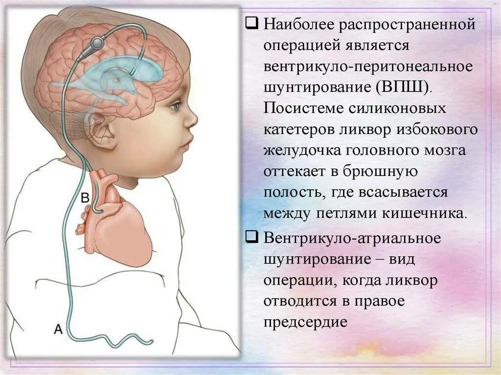 Отек мозга у новорожденных. Вентрикулоперитонеальный шунт схема. Шунт головного мозга при гидроцефалии. Шунт ВПШ вентрикуло-перитонеальный. Вентрикулярный шунт при гидроцефалии.