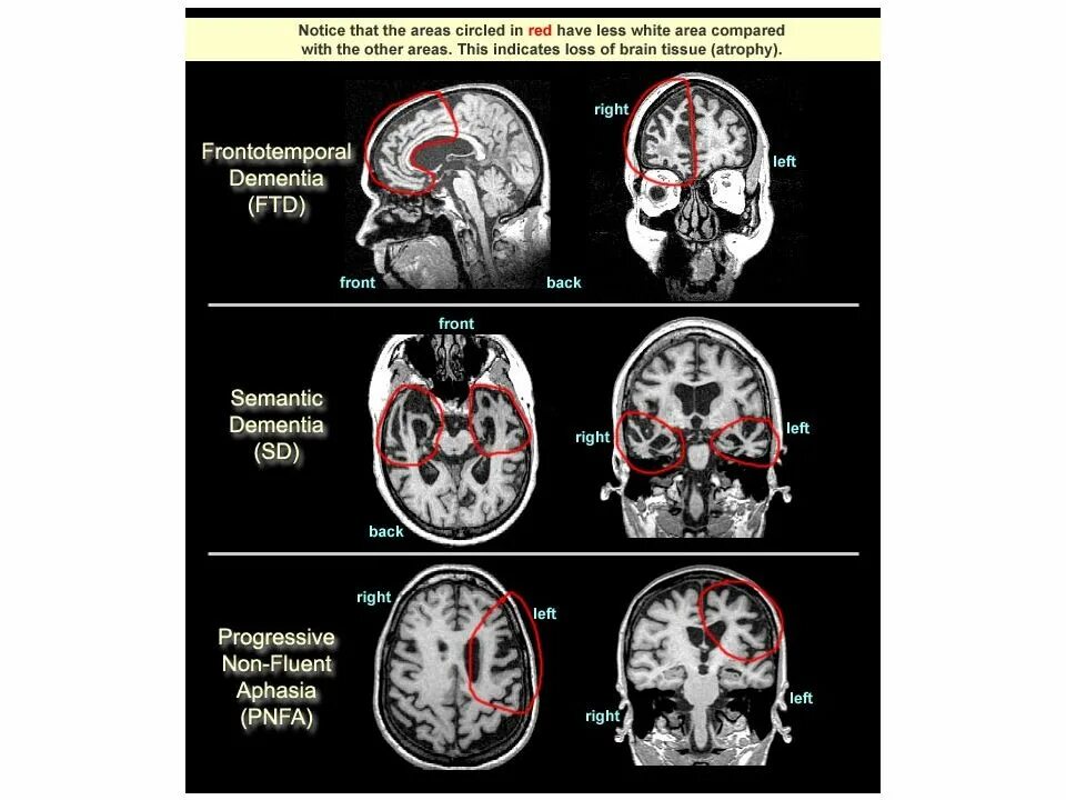 Фронтотемпоральная деменция. Деменция на мрт. Фронто-темпоральная деменция мрт. Фронтотемпоральной деменции это.