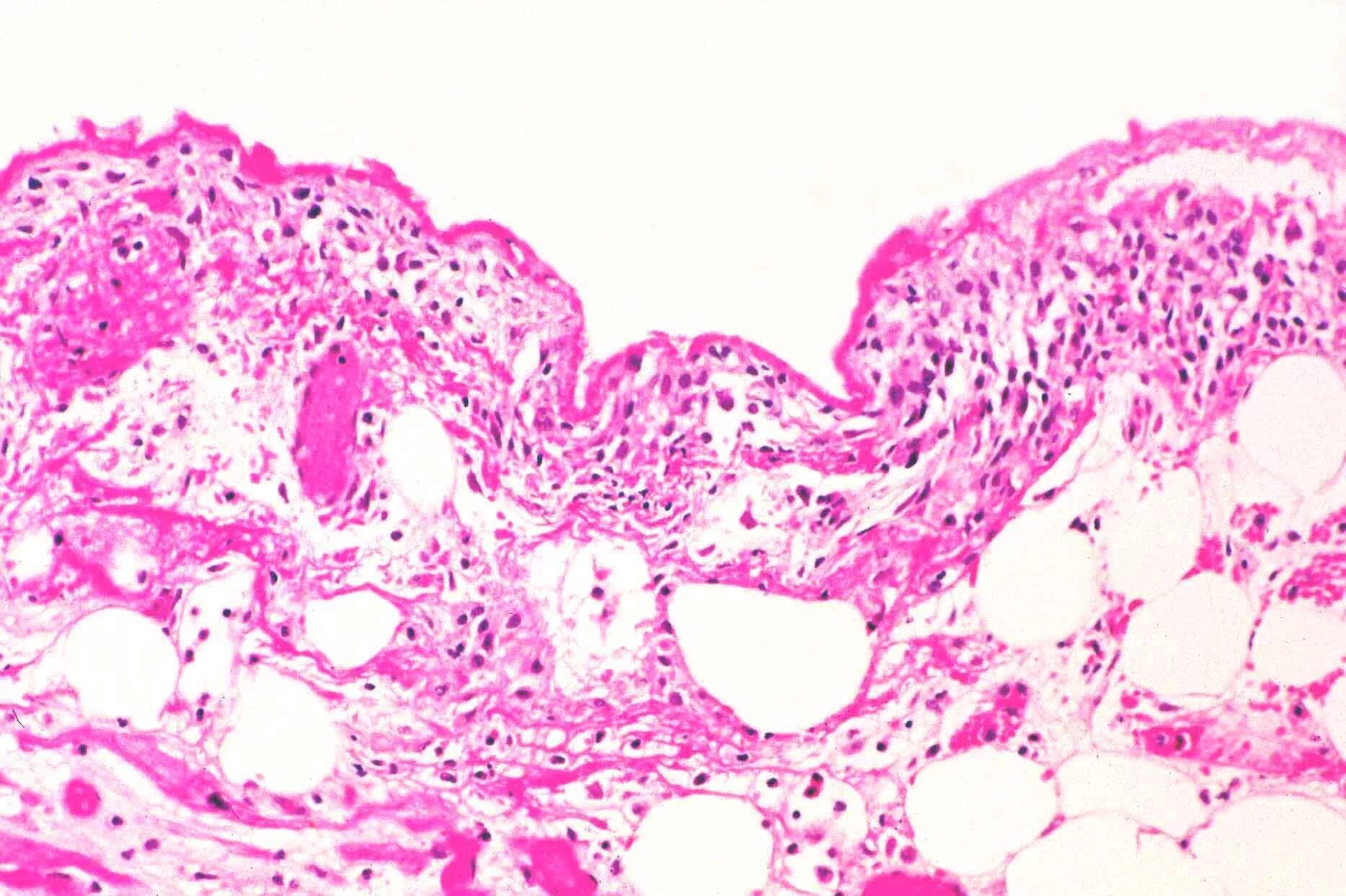 плеврит перикардит