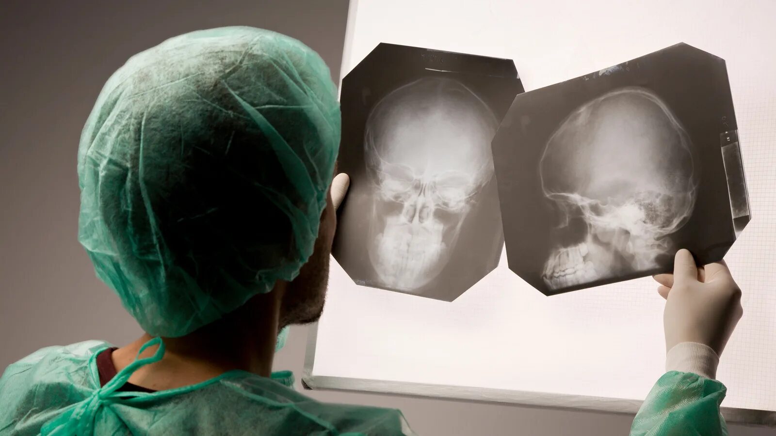 Сотрясение врач. Рентген черепа сотрясение мозга. Закрытая черепно мозговая травма рентген. Черепномазштвая травма. Черепномозговые травы.