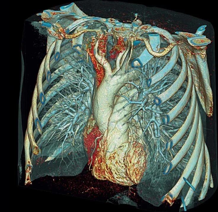 Мультиспиральная кт грудной клетки. Мультиспиральная кт органов грудной клетки. Снимок МСКТ грудной клетки.