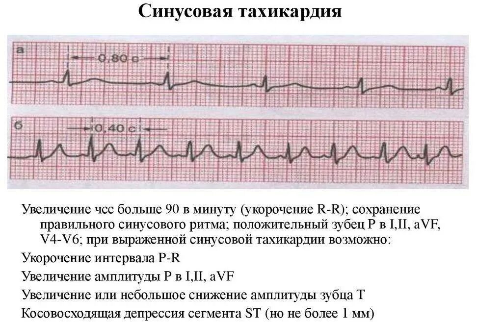 Сердцебиение болезнь. ЭКГ тахикардия синусовый ритм. Синусовая тахикардия ЭКГ признаки. ЭКГ при синусовой тахикардии. Кардиограмма при синусовой тахикардии.