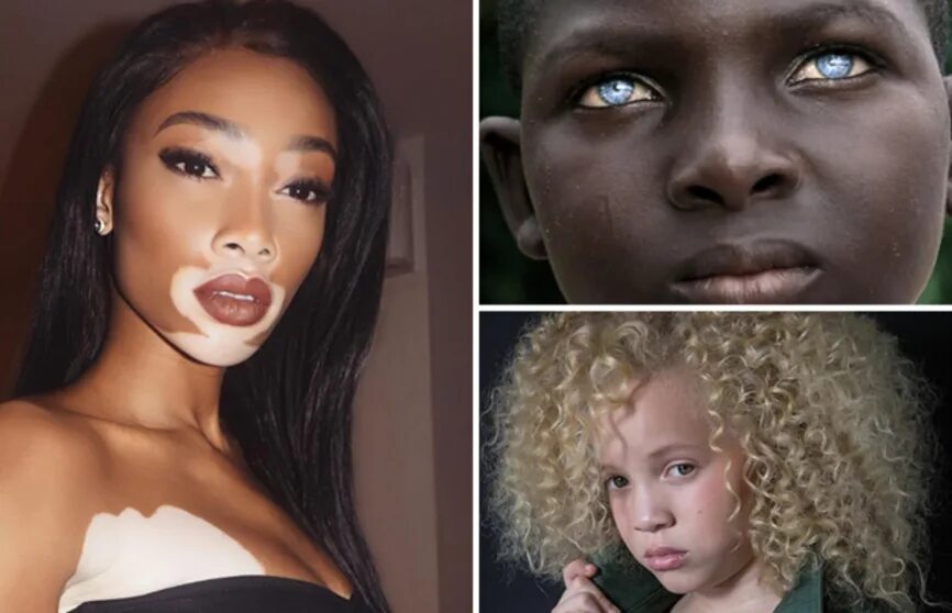 Наследственные аномалии человека. Люди с уникальной внешностью. Люди с разным цветом кожи.