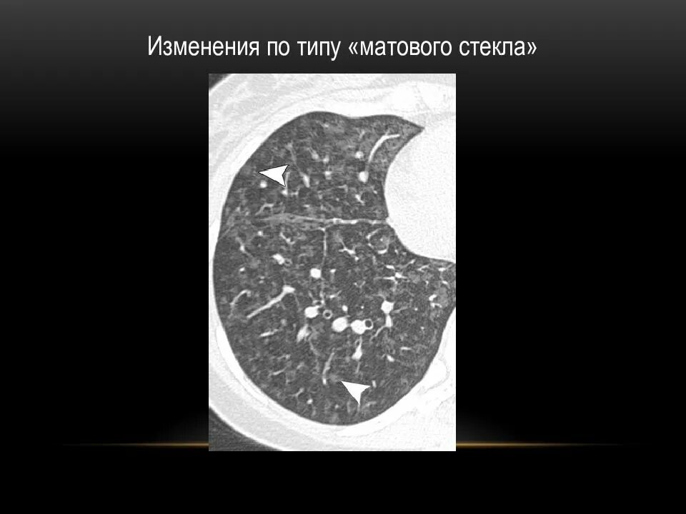 Что такое тип матового стекла. Изменения по типу матового стекла. очаги по типу матового стекла. очаги матового стекла в легких на кт. по типу матового стекла.