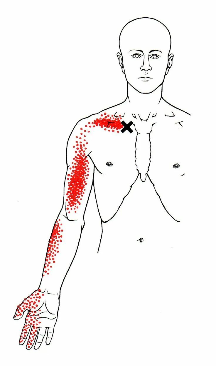 Подостная мышца триггерные точки. Pt referrer. Trigger point. Trigger point therapy. Брахиалис триггерные точки.