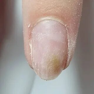 Гель лак грибок