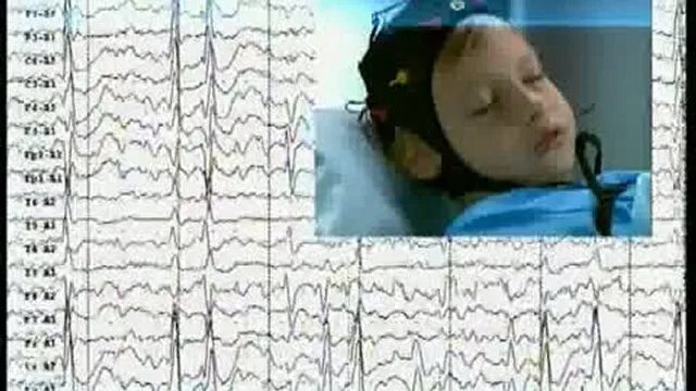 Ээг дневного сна. Ээг со сном ребенку. Ээг мониторинг головного мозга у детей. Ээг мониторинг ночного сна у детей. Ээг холтер дневного сна у детей.