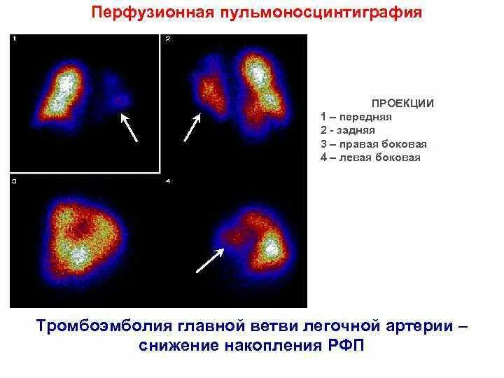 Диагнозы сцинтиграфии