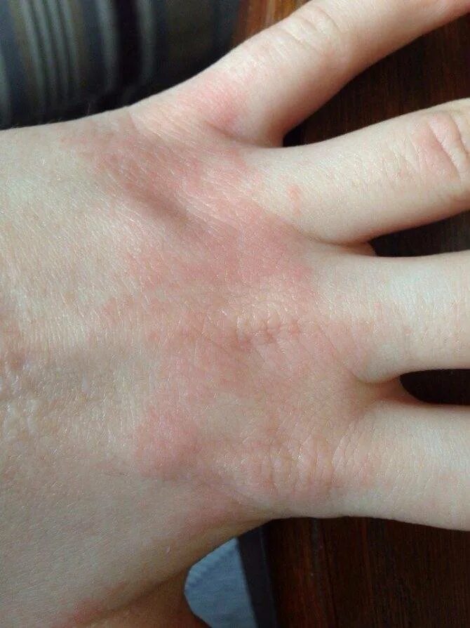 Почему на руках выходят. Фотоаллергический дерматит. Контактный дерматит на руках. Атопический фотодерматит.