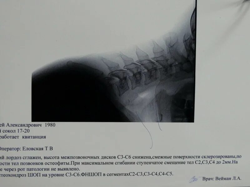 Спинальная нестабильность что это. Нестабильность в шейном отделе позвоночника рентген. Нестабильность сегментов с3-с6. Нестабильность двигательных сегментов с2-с3-с4. Функциональная нестабильность шейного отдела позвоночника рентген.