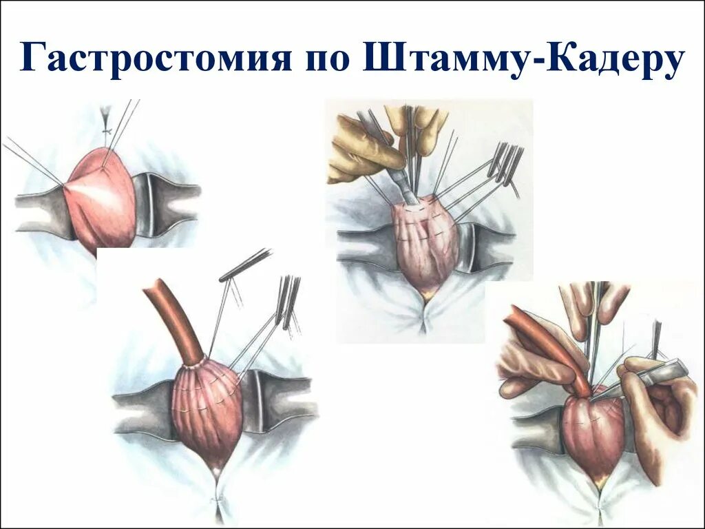 Алгоритм операции наложения. Гастростомия по Витцелю штамм Кадеру Топроверу. Гастростомия по штамму Кадеру техника. Операция гастростомии по способу Витцеля.