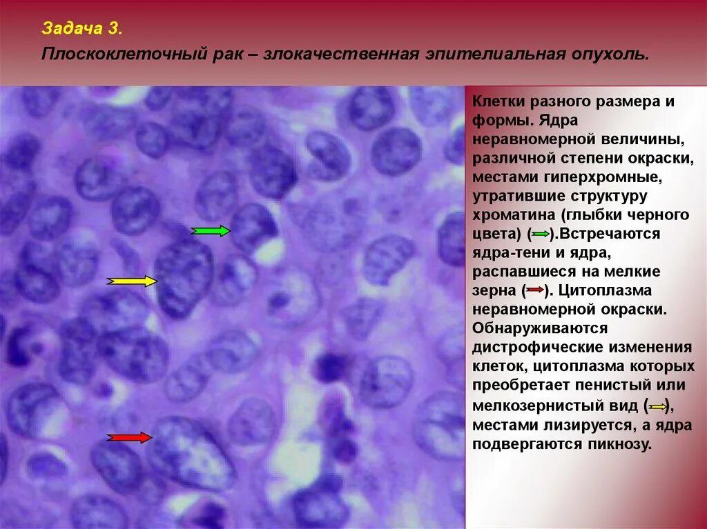 Клетки с гиперхромными ядрами. Ядро опухолевой клетки. Полиморфные клетки с гиперхромными ядрами. Эпителиальные клетки с полиморфными ядрами. Злокачественный потенциал