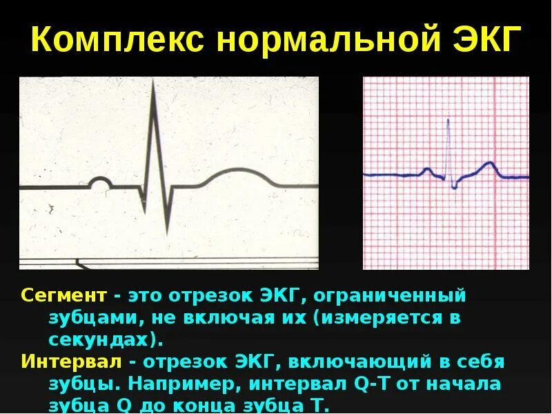 Интервал и сегмент экг. Нормальный комплекс экг. наводка на экг. сегменты экг. презентация на тему экг.