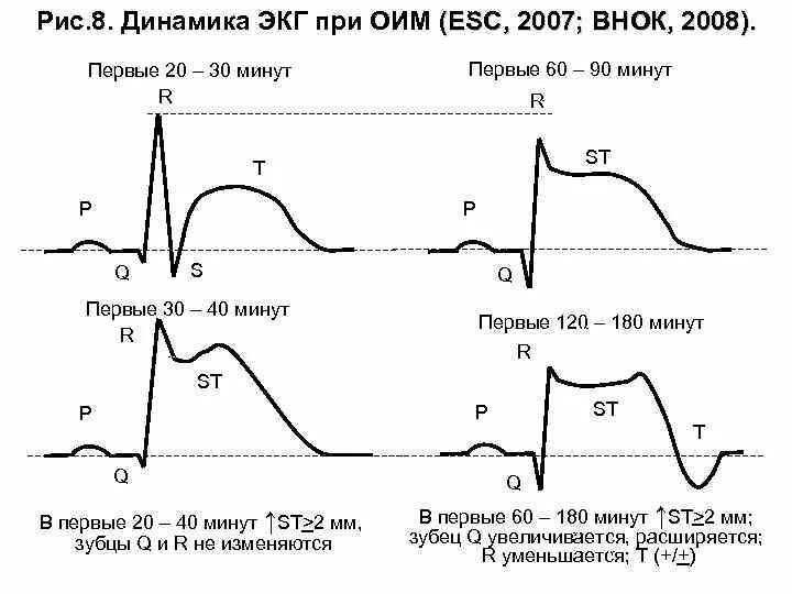 Инфаркт миокарда тесты экг