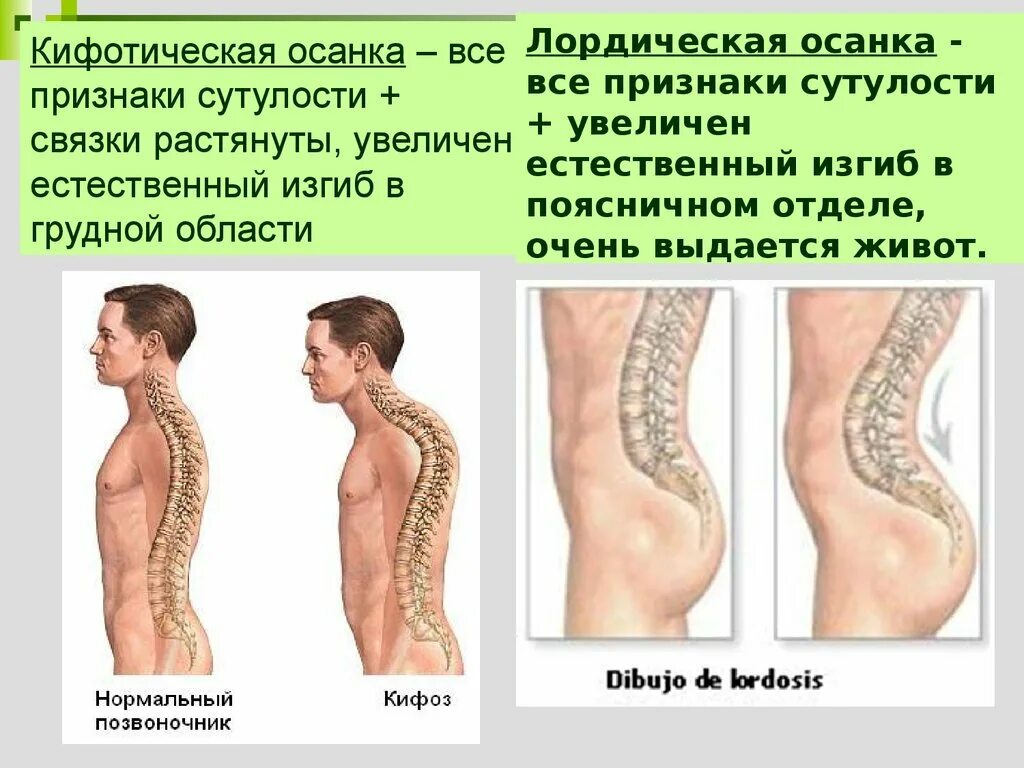 Искривление осанки кифоза. Деформация грудной клетки кифоз. Кифотическая деформация позвоночника. Кифоз грудного отдела позвоночника.