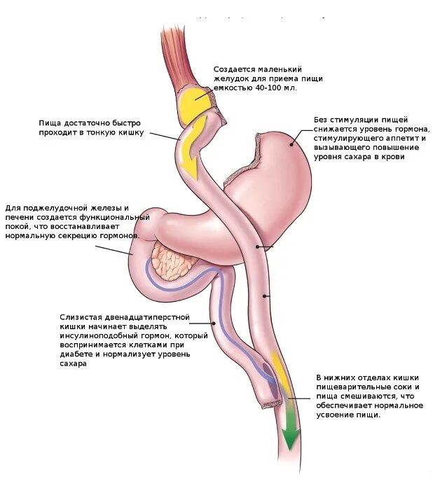Хирургическое лечение сахарного диабета 2 типа. Гастрошунтирование желудка схема операции. Бариатрическая операция при сахарном диабете 2 типа. Желудочное шунтирование.