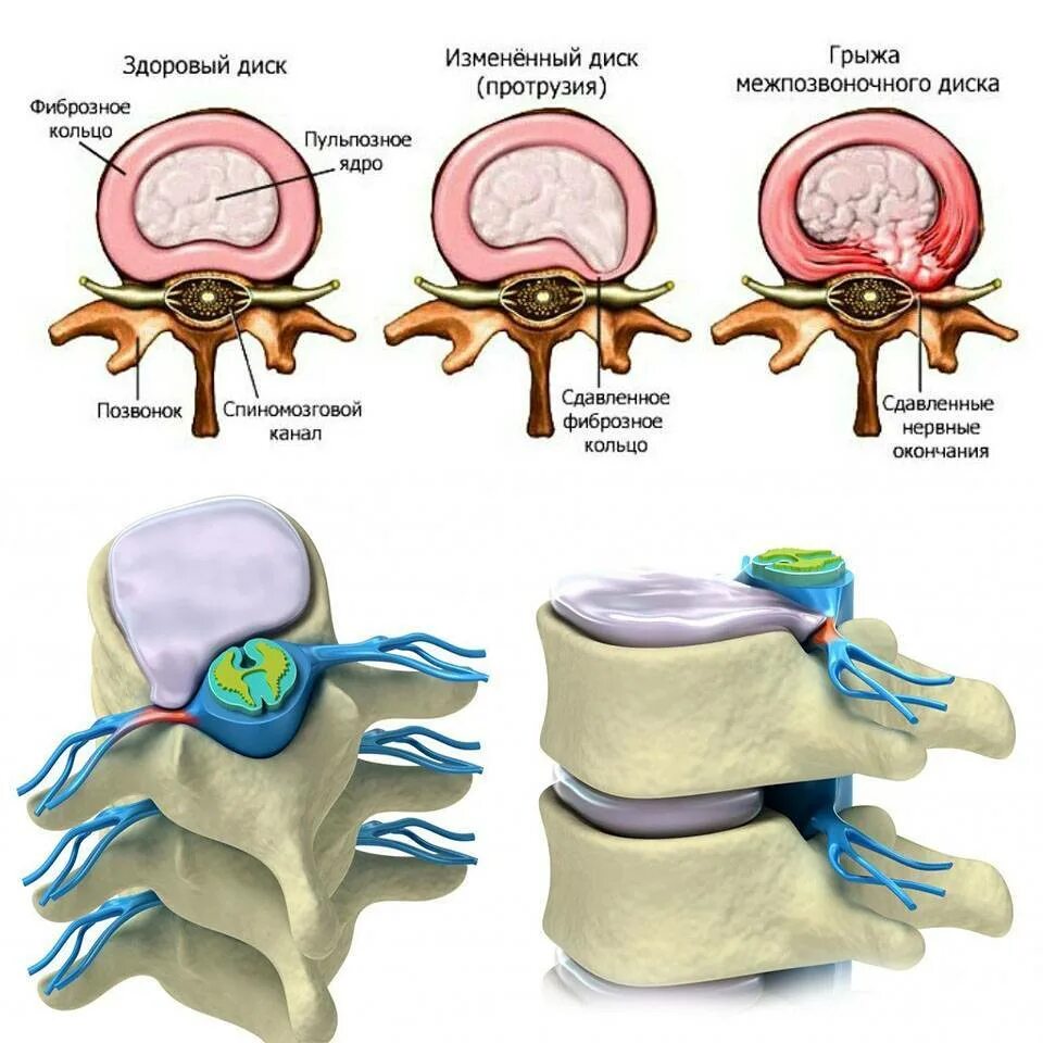 Грыжа мозговых оболочек освобождение нерва. Экструзия диска l5-s1 что это такое. Циркулярная протрузия дисков l4-s1. Циркулярная протрузия межпозвонкового диска l4-l5. Циркулярная протрузия межпозвонкового диска l1 l2.