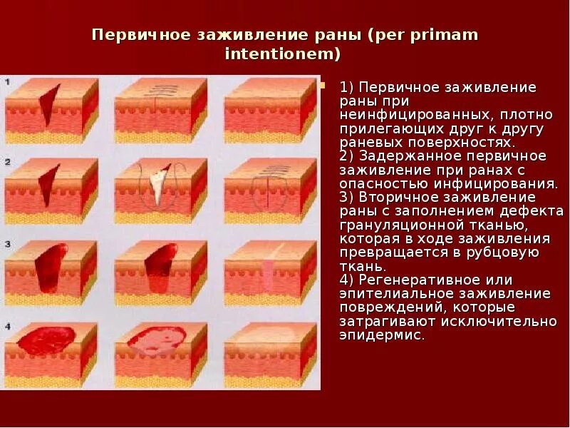 Стадии заживления резаной раны. Заживления РАН грануляция. Этапы заживления РАН вторичным натяжением. Грануляция тканей этапы заживления РАН.