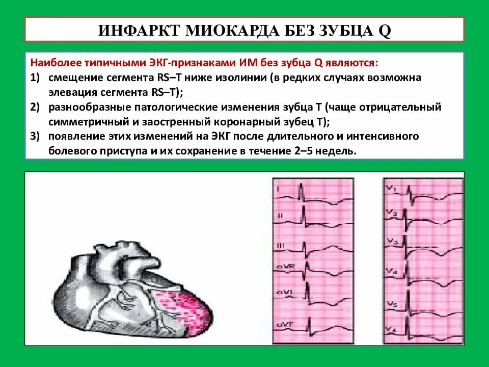 Образующий инфаркт. Острый передний инфаркт миокарда без зубца q. не q образующий инфаркт миокарда экг. инфаркт миокарда без зубца q на экг. зубец q при инфаркте миокарда.