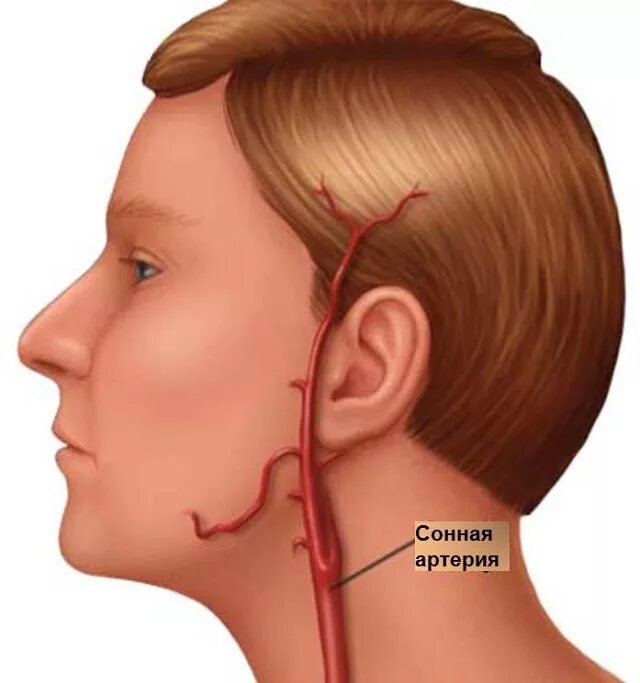 Закупорка головных сосудов. Сонная артерия на шее расположение. Атеросклероз сосудов сонных артерий.