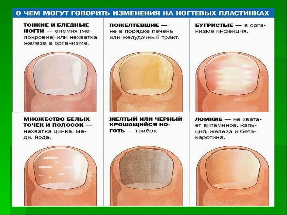 Изменение формы и окраски. Типы поражения ногтевой пластины. Негрибковые заболевания ногтей таблица. Изменение ногтевой пластины. Определить заболевание по ногтям.