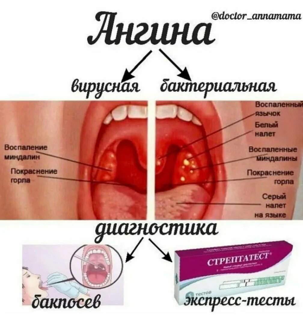 Сыпь температура боль в горле у ребенка. Бактериальная фолликулярная ангина. Герпесная ангина и бактериальная. Язвенно-плёнчатая форма тонзиллита.