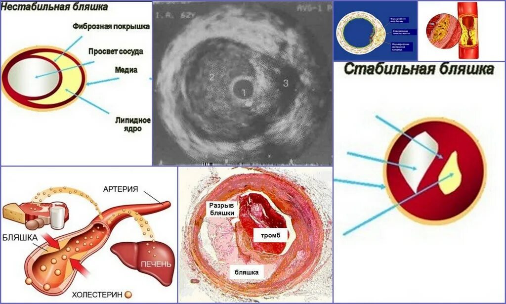 Разрыв бляшки. Атеросклеротическая бляшка коронарной артерии. Полуконцентрическая атеросклеротическая бляшка. Причины нестабильной атеросклеротической бляшки. Нестабильная атеросклеротическая бляшка гистология.