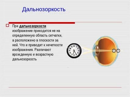 Дальнозоркость очки плюс