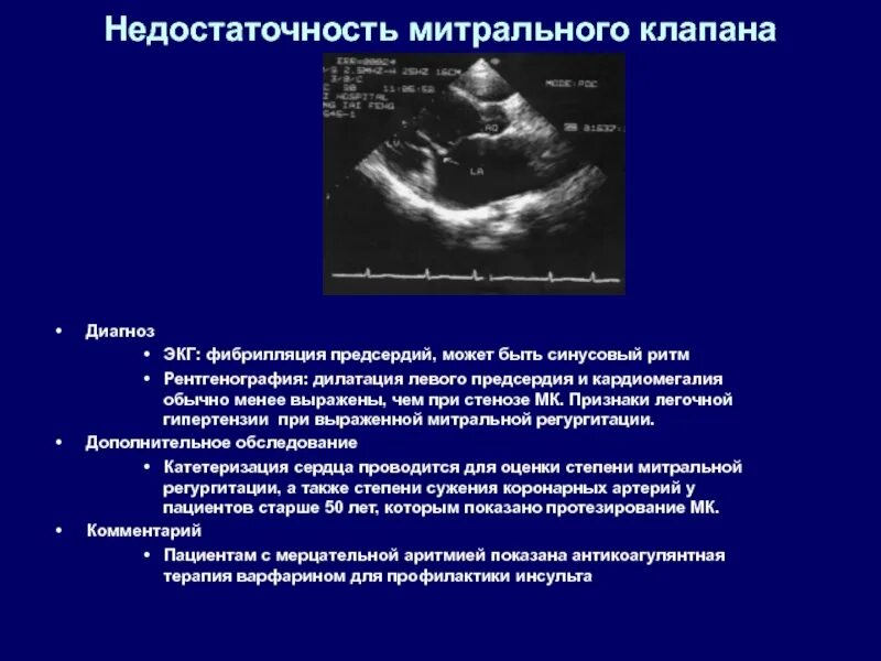 Сердечная недостаточность митрального клапана. УЗИ сердца митральная недостаточность. Митральная недостаточность эхокардиография. Недостаточность митрального клапана заключение. Заключение ЭХОКГ при стенозе митрального клапана.