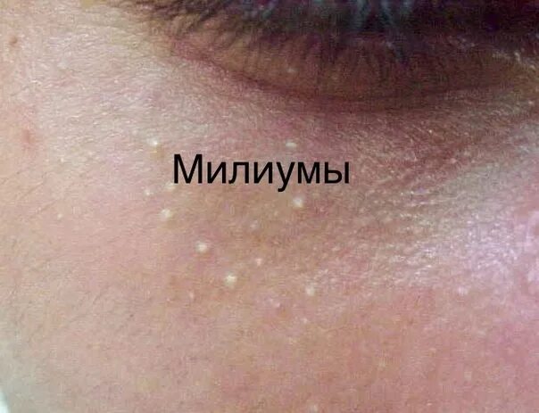 Милиум фото выдавленогт. Глаз эссенция. Фламена крем для лица. Мазь от милиумов под глазами отзывы. Милиум фото выдавленогт.