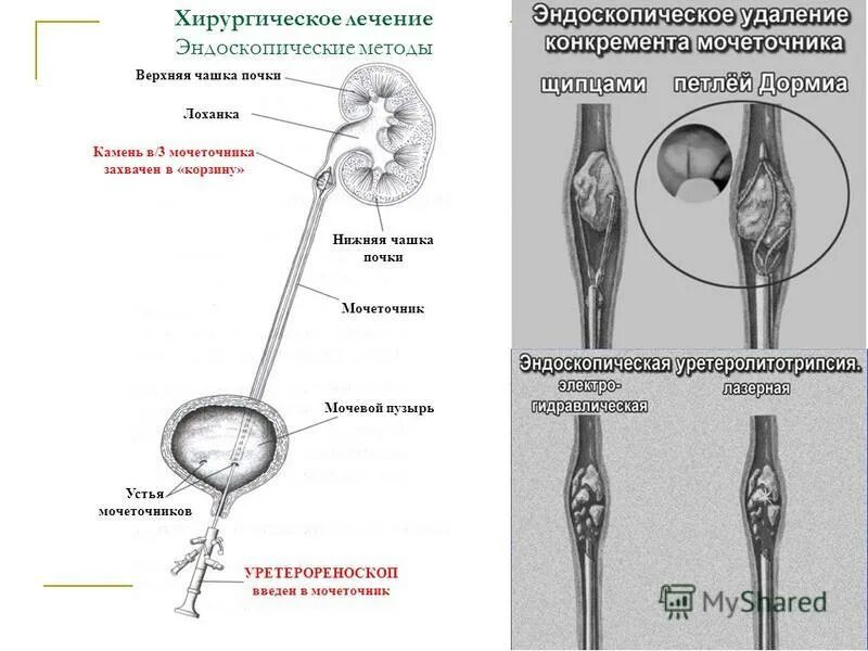 Сколько стоит операция по удалению камней