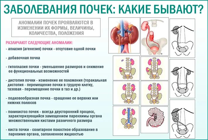 Заболевание почек 6. Заболевания почек названия болезней и симптомы и лечение. Общие симптомы патологии почек. Почки заболевания почек. Основные формы заболевания почек.