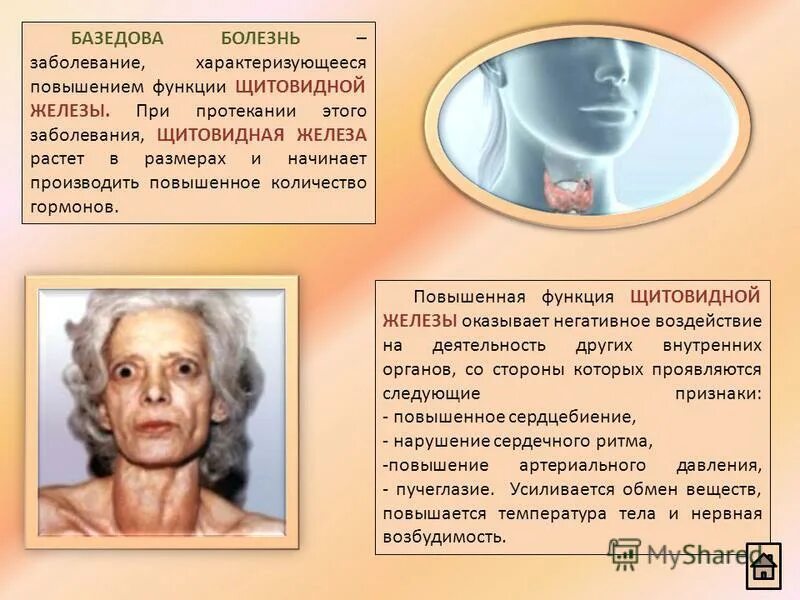 базедова болезнь гиперфункция. тиреотоксический зоб щитовидной железы. клинические симптомы базедовой болезни. гиперфункция щитовидной железы. базедова болезнь развивается при щитовидной железе.