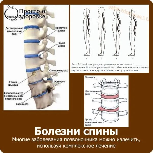 Как называется нарушение позвоночника