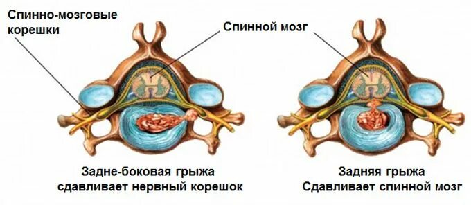 Как появляется грыжа позвоночника. Протрузия дисков позвоночника что это такое. протрузия экструзия. экструзии межпозвонковых дисков. экструзия дисков позвоночника что это такое.