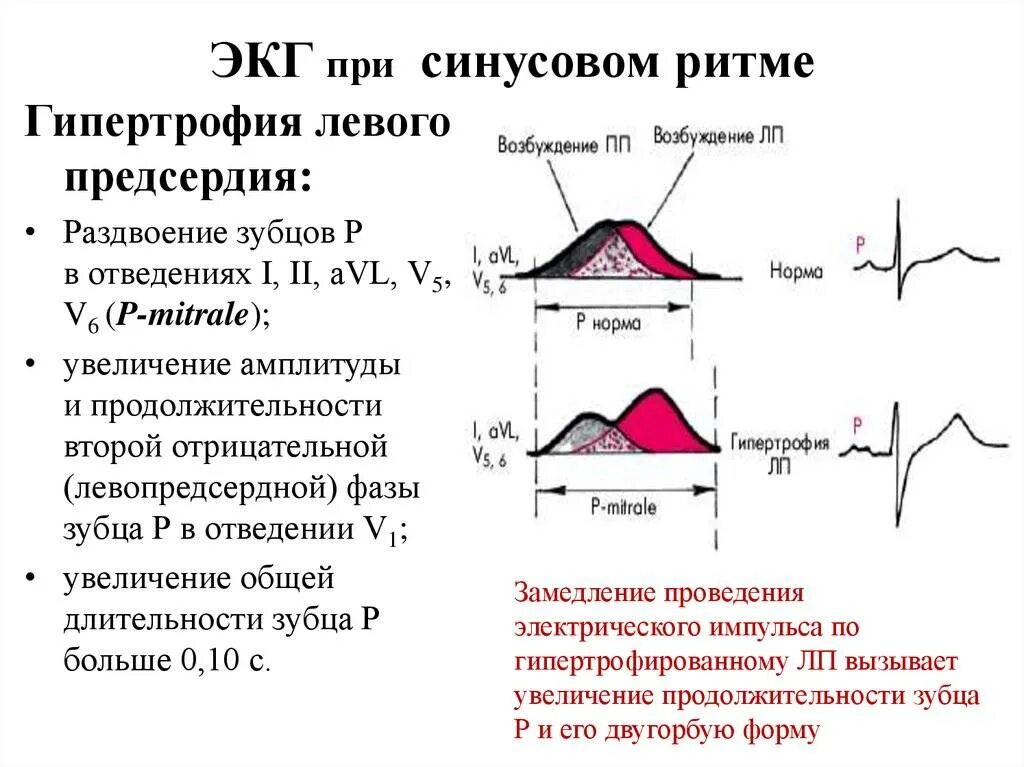 Кардиограмма сердца расшифровка синусовый ритм норма. Норма ЭКГ синусный ритм. ЭКГ нормальные синусовый ритм норма. ЭКГ ритм синусовый 70 в минуту норма. Норма правого предсердия