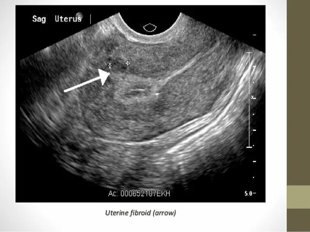 Субсерозная миома матки УЗИ. УЗИ миома матки субсерозный узел.