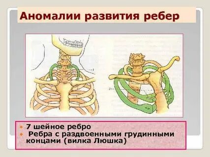 Аномалии строения грудины