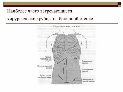 Стенки рубца