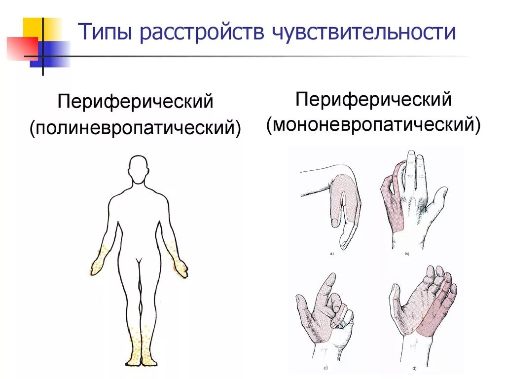 Периферический мононевритический Тип нарушения чувствительности. Мононевропатический Тип расстройства чувствительности. Пластический Тип нарушения чувствительности. Периферический Тип нарушения чувствительности схема.