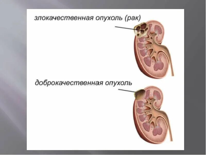 Темноклеточная аденома почки. Доброкачественная опухоль и злокачественная опухоль почки отличия. Доброкачественная опухоль и злокачественная опухоль картинки. Новообразование в почке. Злокачественный характер