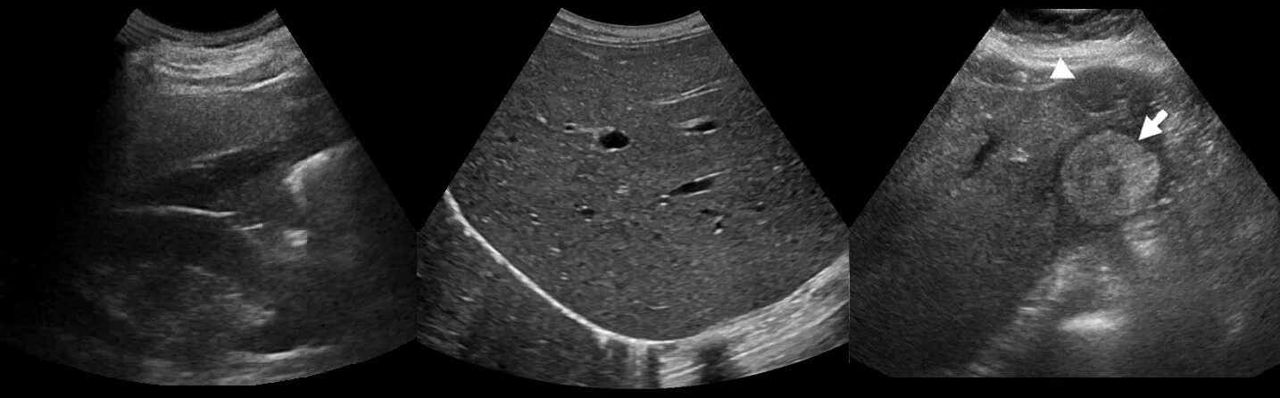 Пониженная эхогенность печени. Трансабдоминальная ультрасонография желчного пузыря. УЗИ печени патология Изранов. УЗИ печени и желчного пузыря. Гепатоцеллюлярная карцинома печени на УЗИ.